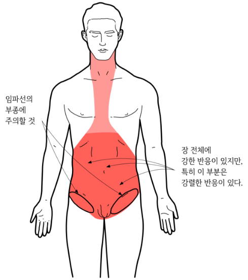 대장암1