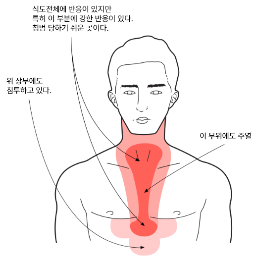 식도암온열법01